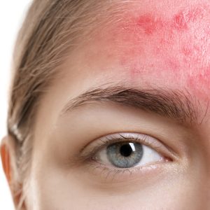 脂漏性皮膚炎の治し方