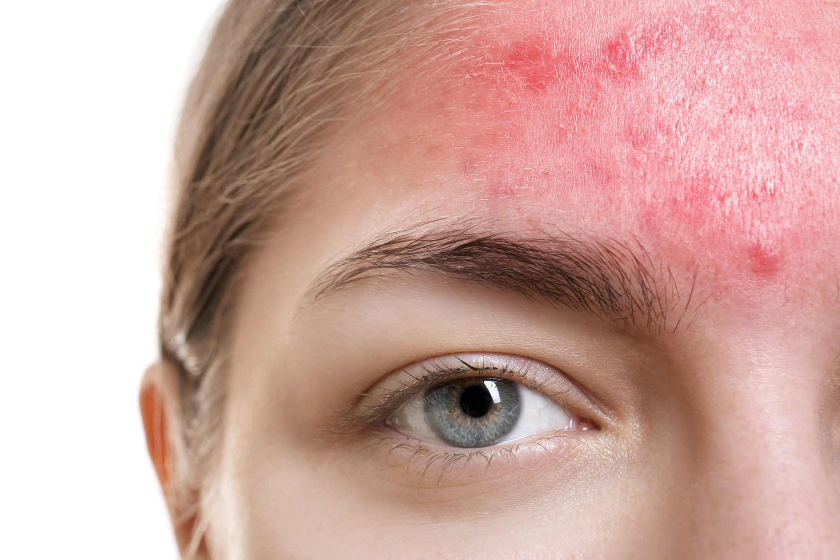 脂漏性皮膚炎の治し方